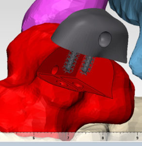 computer rendering of the custom implant technique