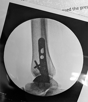 surgery photo showing the final implant