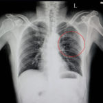 X-Ray of a Broken Rib