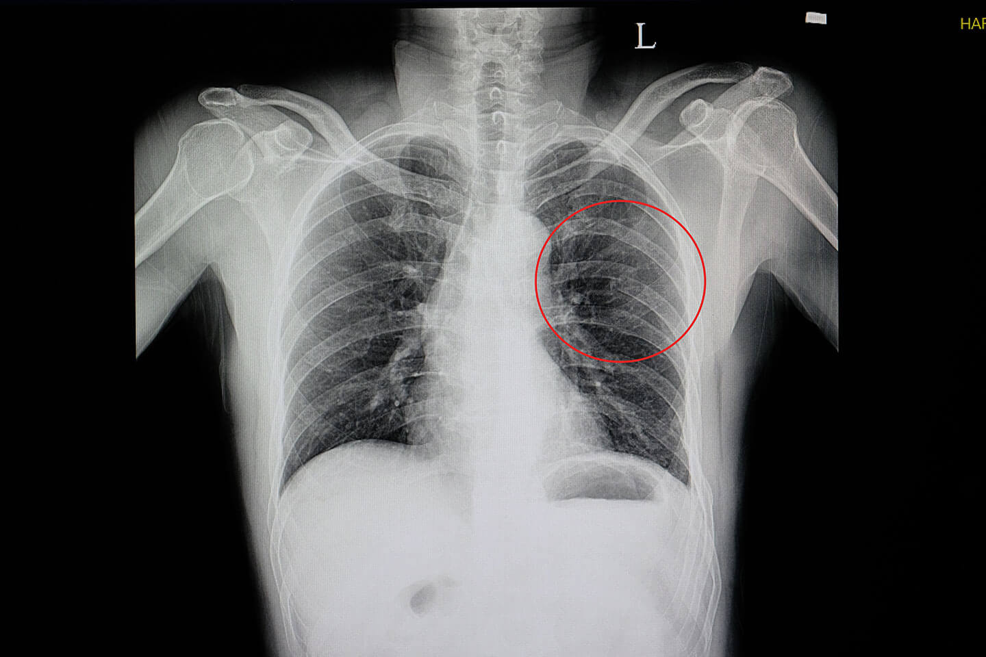 X-Ray of a Broken Rib