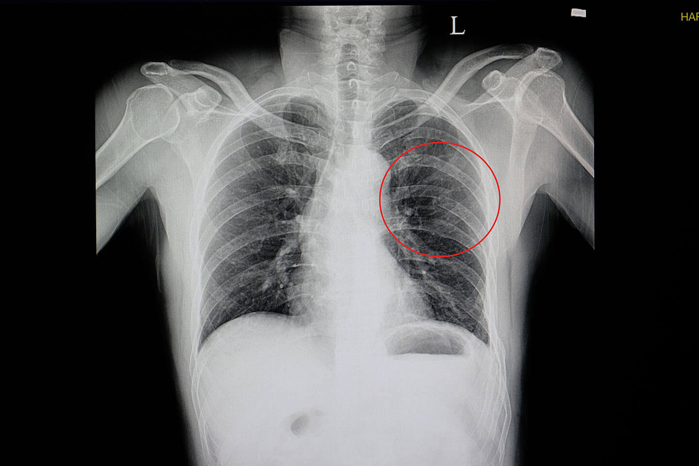 Broken or Cracked Rib Symptoms Alexander Orthopedic Associates