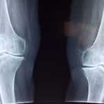 X-ray of knees