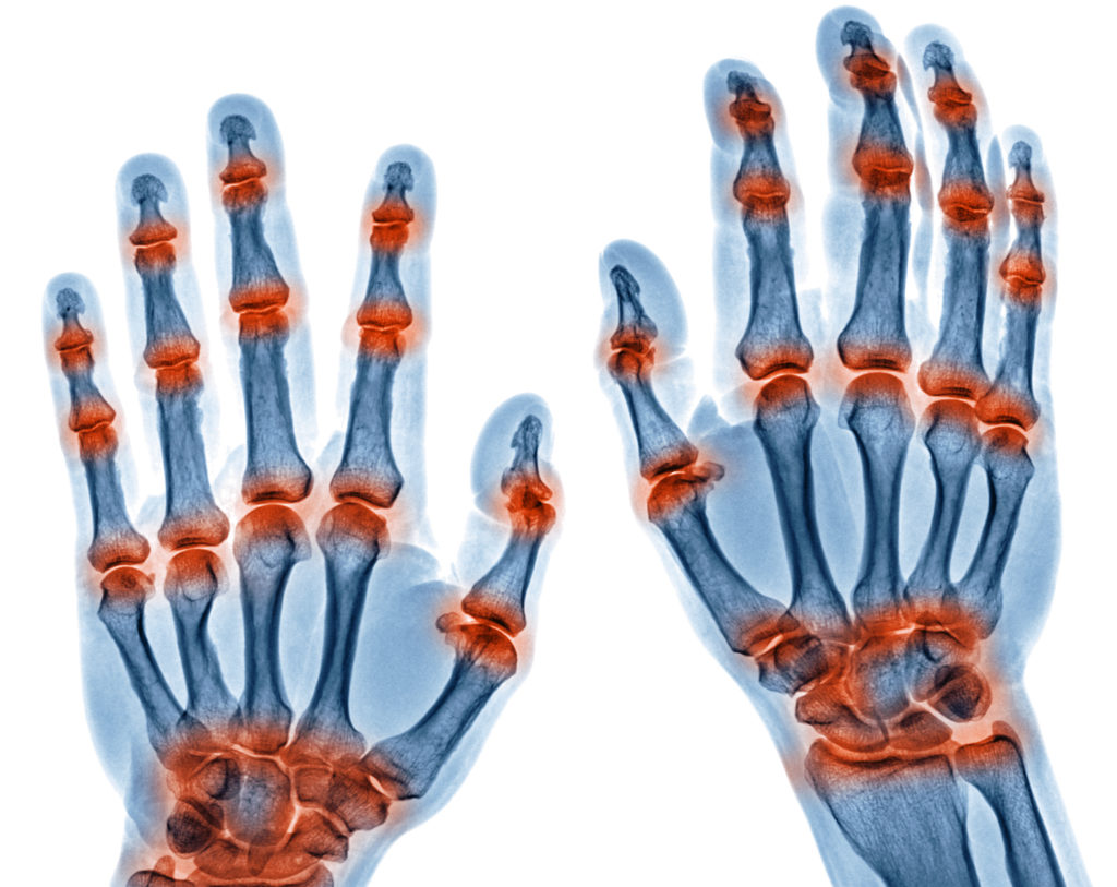 x ray image of multible joint inflammation in both hands caused by Gout arthritis, Rheumatoid arthritis isolated on white background