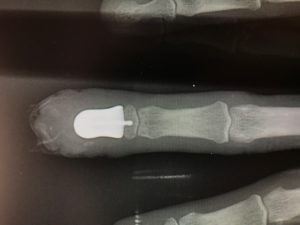 X-Ray of 3D Printed Finger Bone Implant