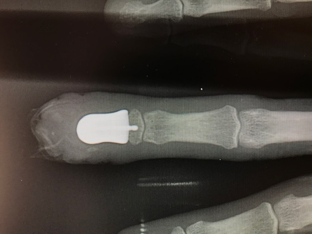 X-Ray of 3D Printed Finger Bone Implant