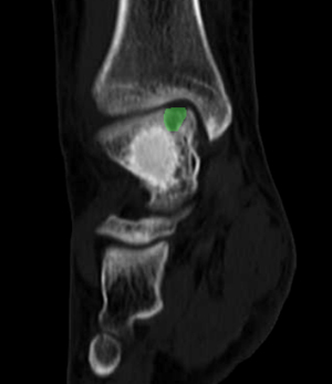 CT scan of the patient's ankle defect