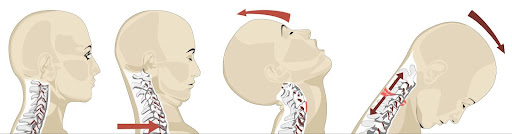 Illustration of how the neck and spine are injured during whiplash