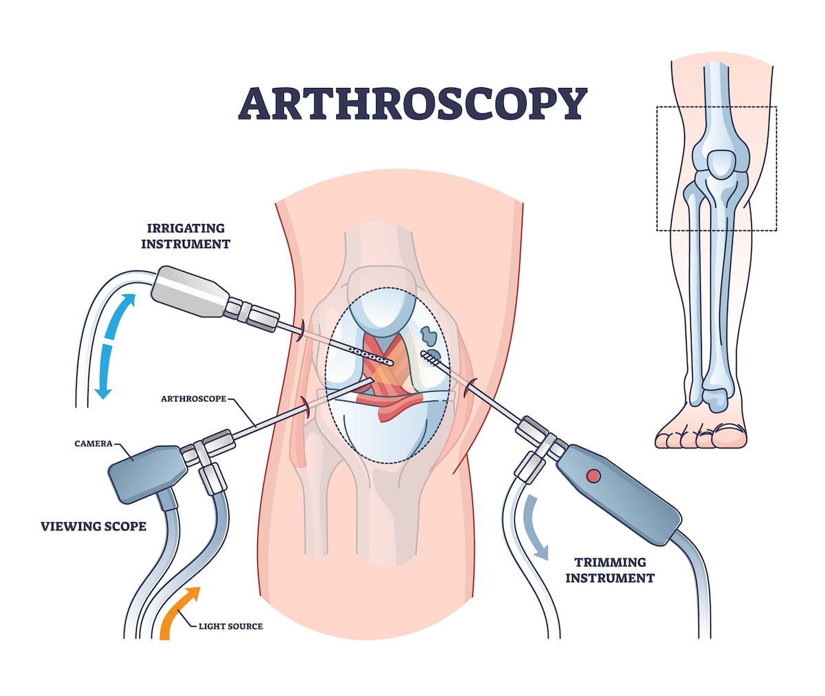 Diagram showing where the viewing scope, irrigating instrument, and trimming instrument are used during knee arthroscopy