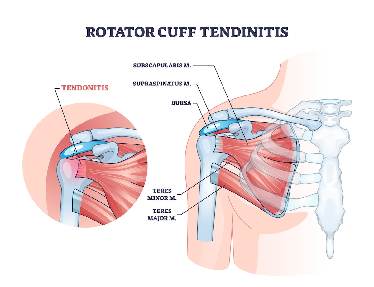 Diagram of rotator cuff (shoulder) tendonitis